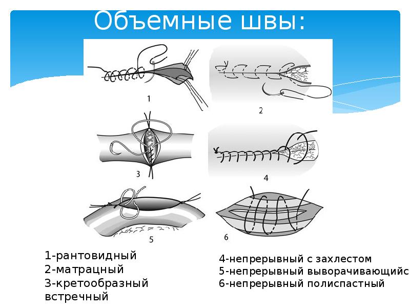 Виды хирургических швов и узлов фото