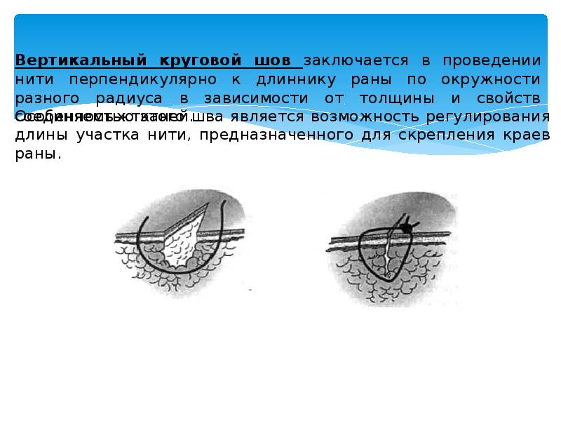 Виды хирургических швов презентация