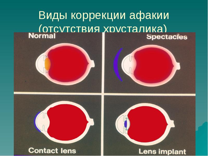 Виды коррекции. Коррекция афакии. Очковая коррекция афакии. Коррекция односторонней афакии. Современные методы коррекции афакии.