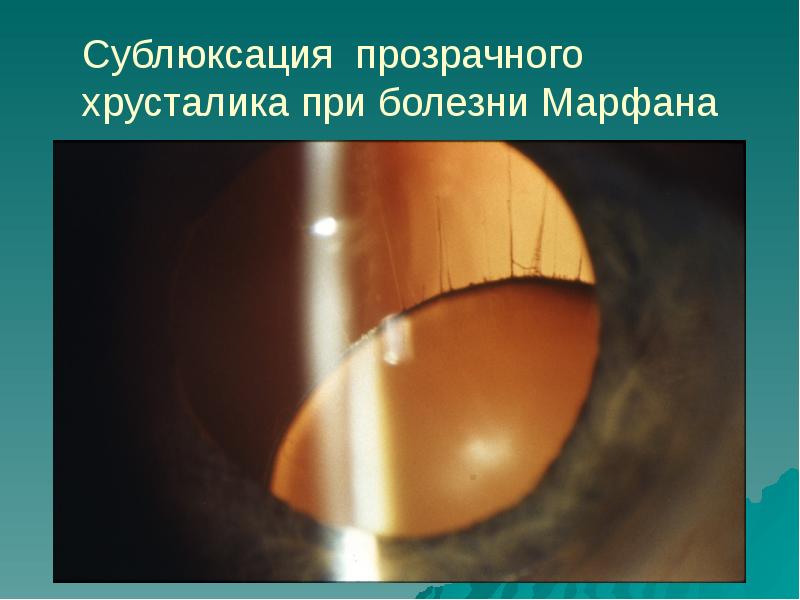 сублюксация. сублюксация позвонков. сублюксация. мышцы поясничного отдела сзади. сублюксация хрусталика гелмьголса.