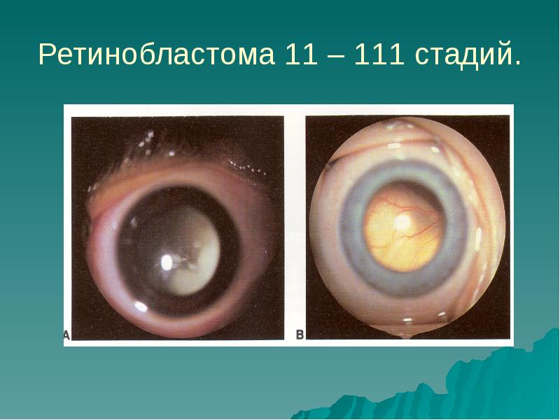 Ретинобластома. Ретинобластома офтальмоскопия. Ретинобластома патанатомия. Криодеструкция ретинобластома. Экзофитная ретинобластома.