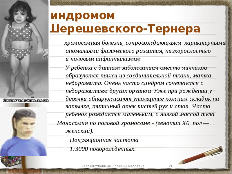 Низкорослость. Синдром Шерешевского Тернера половой инфантилизм. Хромосомные болезни у детишек. Болезнь Шерешевского наследуется.