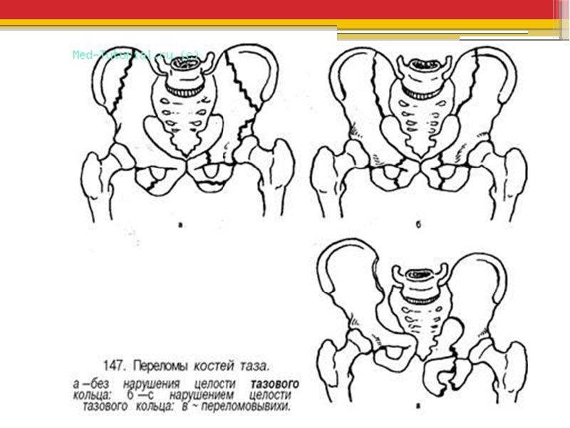 Переломы костей таза презентация