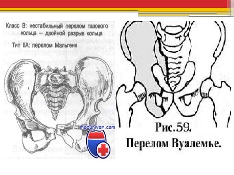 Переломы костей таза презентация
