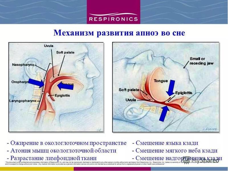 Синдром пиквика картинки