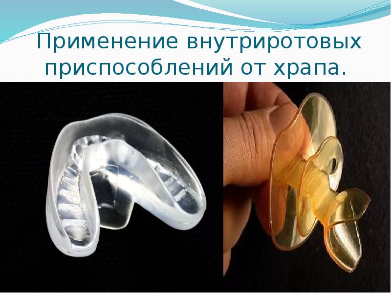 Применение внутриротовых приспособлений от храпа. Применение внутриротовых приспособлений от храпа.