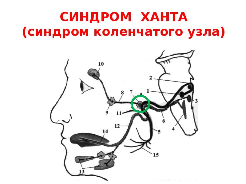 Схема поражения лицевого нерва на разных уровнях