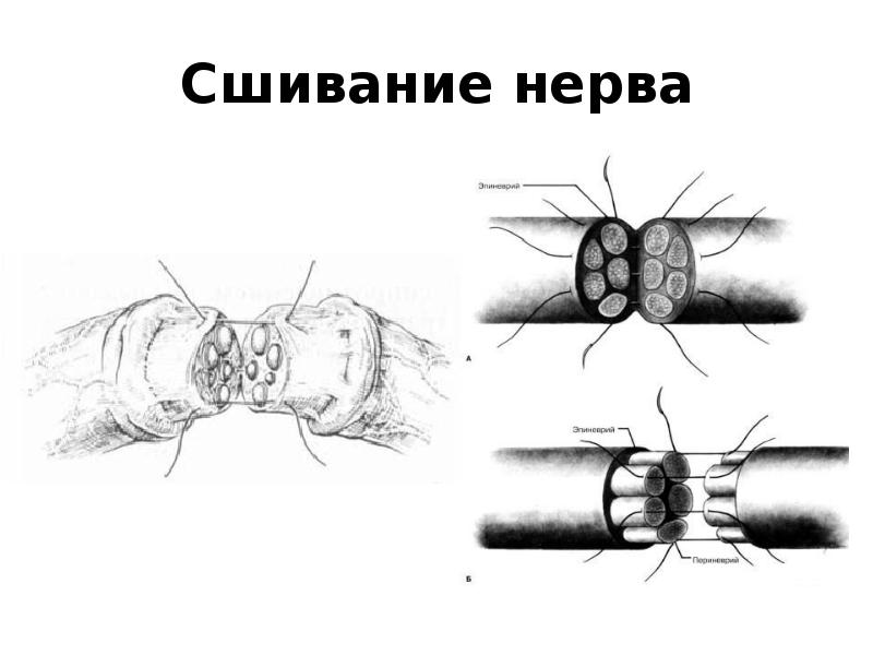 Нейропатия лицевого нерва картинки