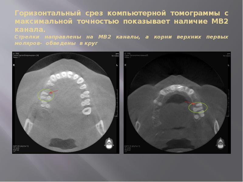 Mb канал. Кт горизонтальный срез. Мезиобуккальный корневой канал это. Дополнительные каналы моляров.