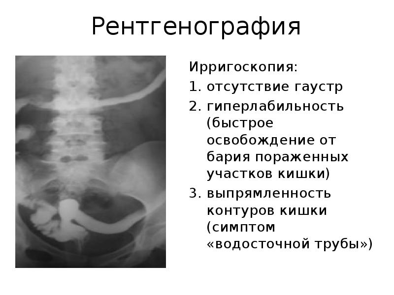 Рентген ирригоскопия. Сглаженность гаустр в кишечнике.