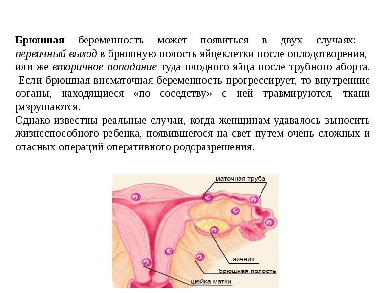 Абдоминальная беременность