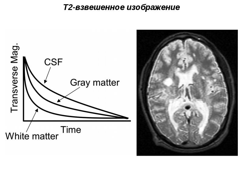 Взвешенное изображение мрт