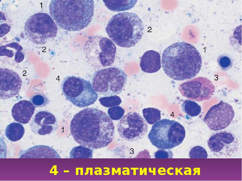 Миеломная болезнь картина крови