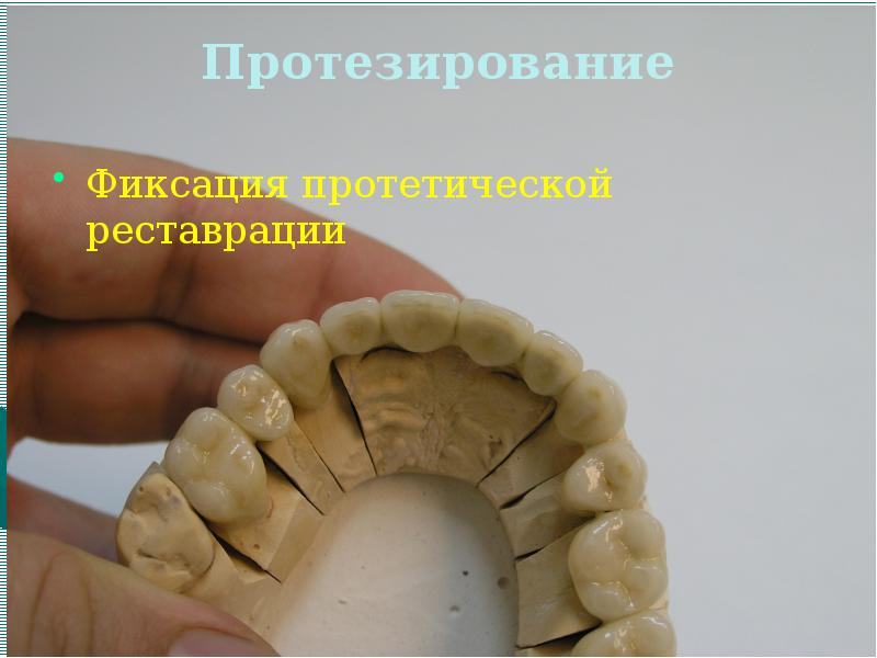 Оттиски в ортопедической стоматологии презентация