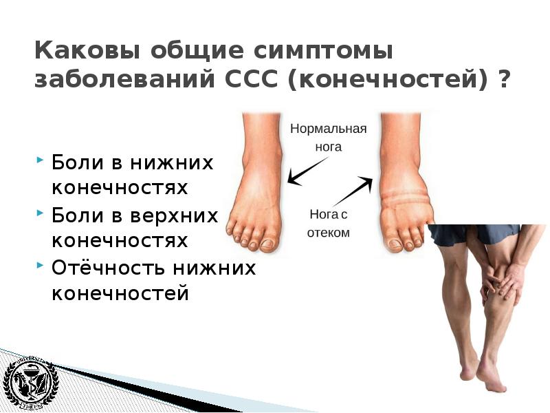 Нижний поражение. Отечность нижних конечностей. Отеки нижнихонечносте. Отек нижних конечностей ног. Отёки на ногах характерны для заболеваний:.