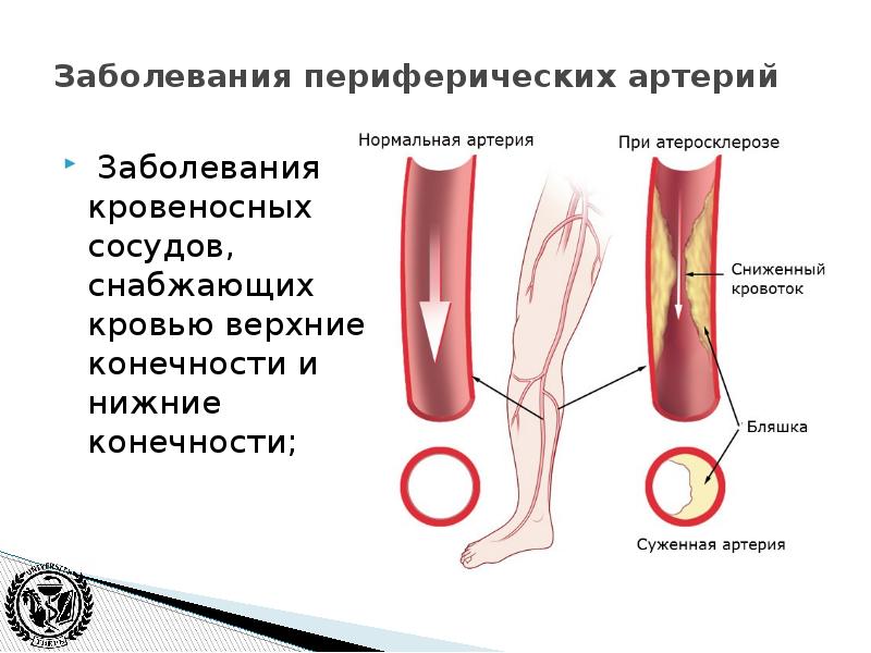 Нарушения сосудов. Болезнь периферических артерий. Периферические сосуды нижних конечностей. Заболевания артерий периферических вен. Заболевание периферических артерий (ЗПА).