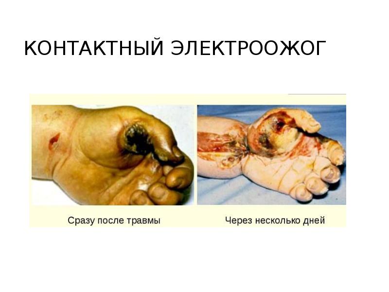 Контактный электроожог Контактный электроожог