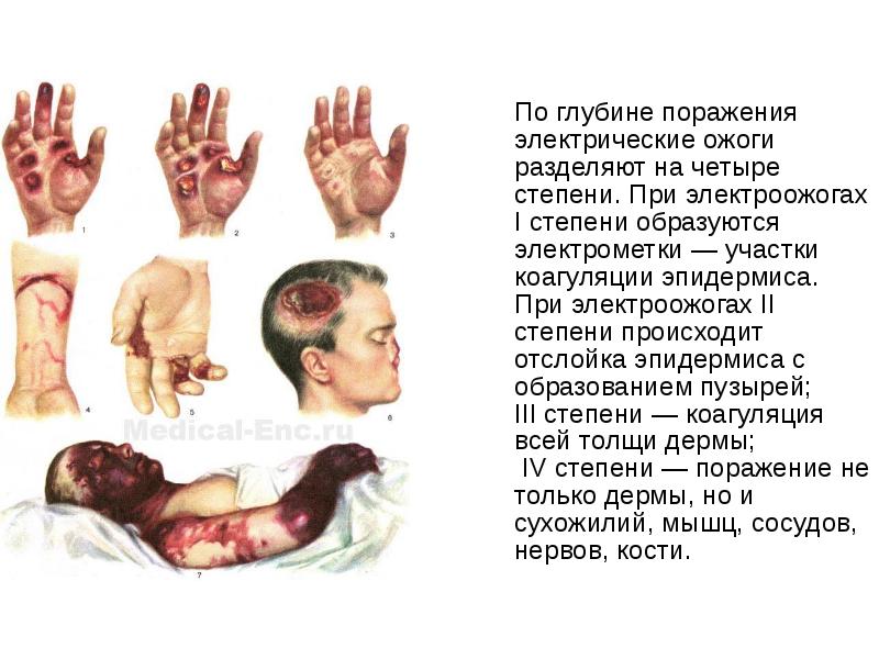 По глубине поражения электрические ожоги разделяют на четыре степени. При электроожогах По глубине поражения электрические ожоги разделяют на четыре степени. При электроожогах