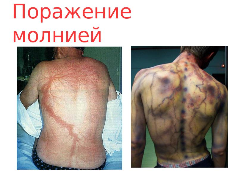 Поражение молнией Поражение молнией