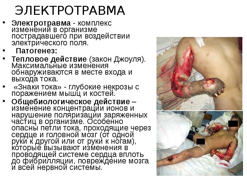 Электротравма
Электротравма - комплекс изменений в организме пострадавшего при воздействии электрического Электротравма
Электротравма - комплекс изменений в организме пострадавшего при воздействии электрического