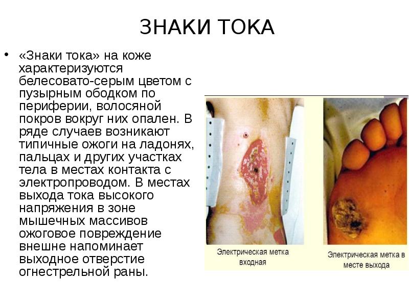 Знаки тока
«Знаки тока» на коже характеризуются белесовато-серым цветом с пузырным Знаки тока
«Знаки тока» на коже характеризуются белесовато-серым цветом с пузырным