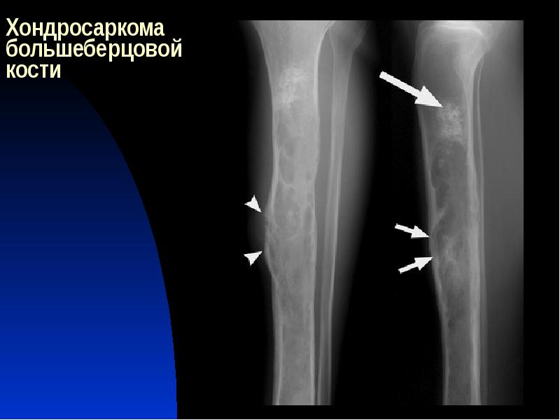 Хондросаркома. Хондросаркома бедренной кости кт. Хондросаркома большеберцовой кости рентген. Периостит бедренной кости кт. Хондросаркома рентгенодиагностика.