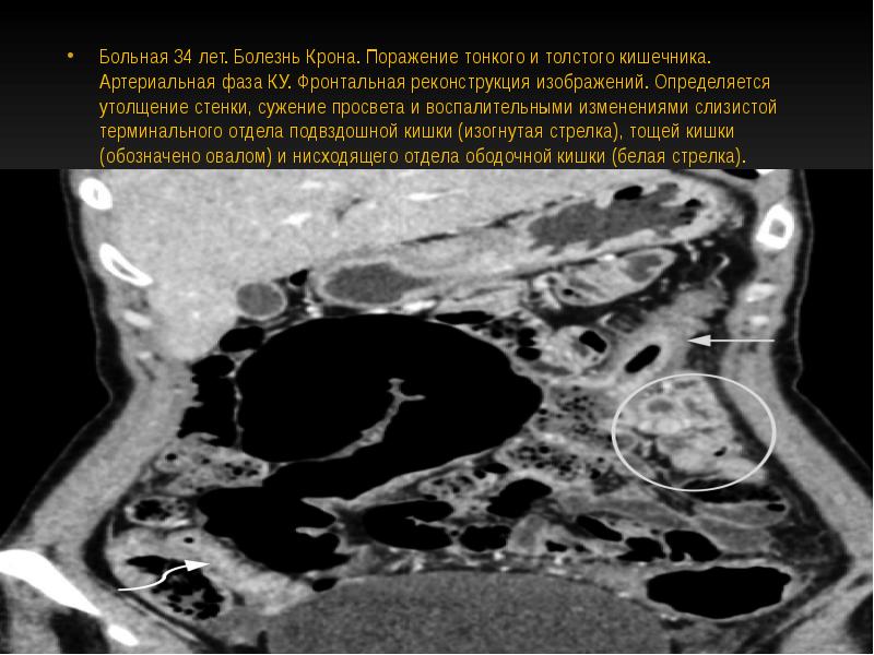 Утолщение стенок. Утолщение стенок кишечника на кт. Утолщенная стенка тонкого кишечника.