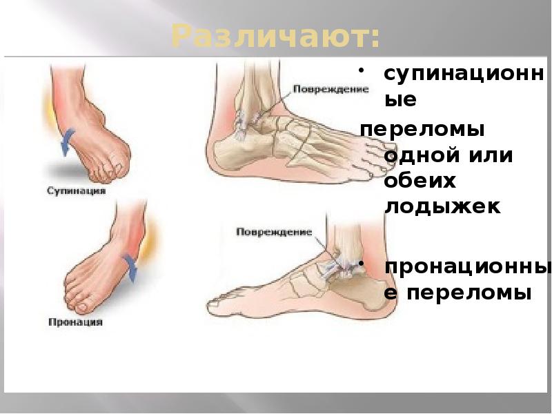 Закрытый перелом наружной лодыжки карта вызова скорой помощи