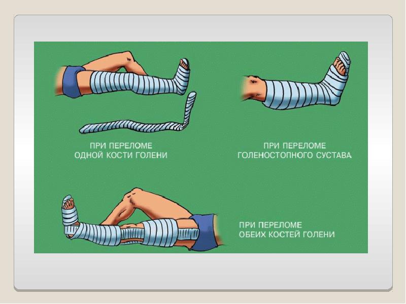 Переломы виды переломов первая помощь презентация