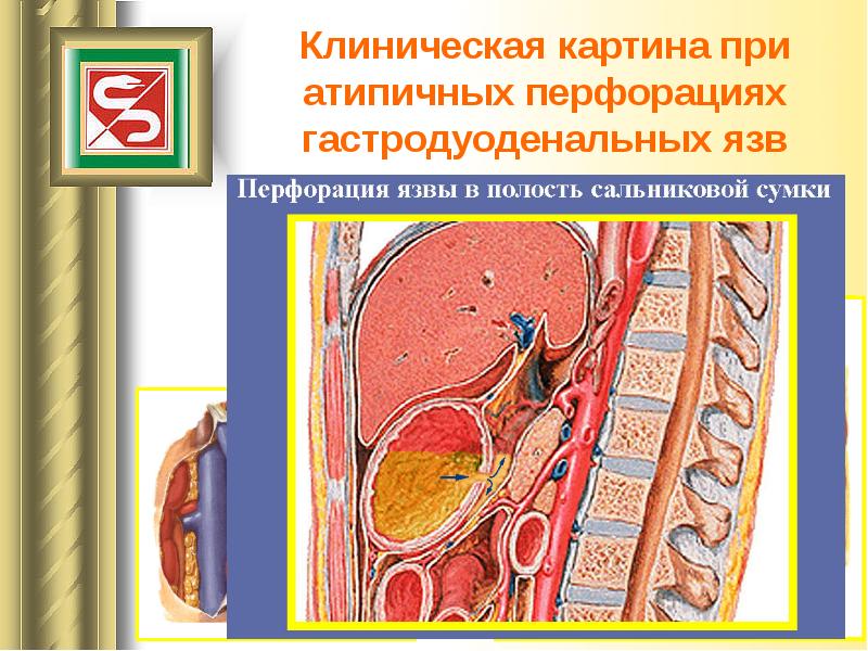 Перфоративная язва презентация