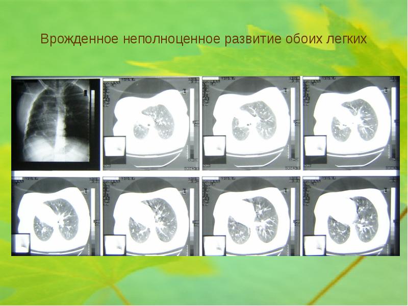 Пороки Развития Трахеи