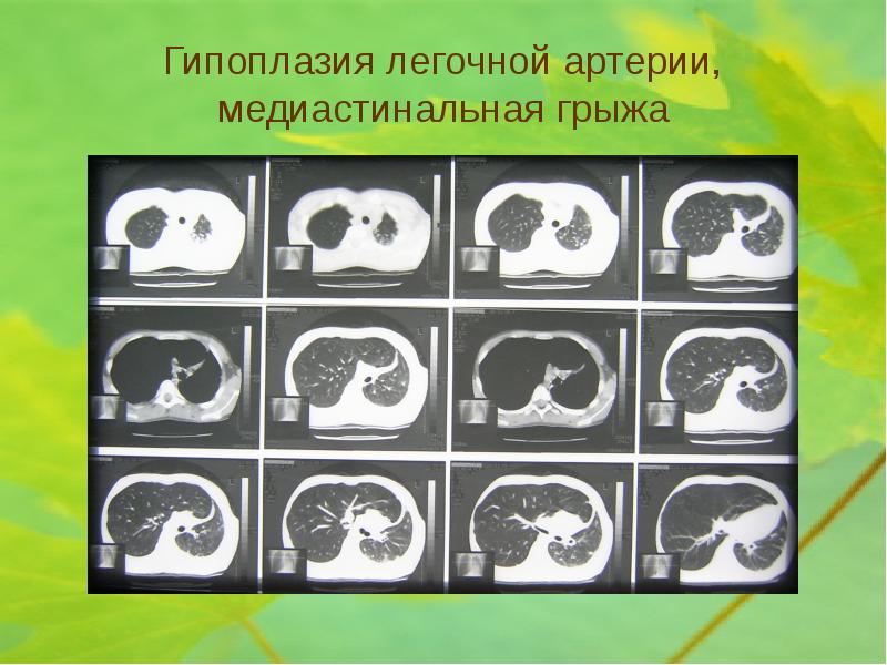 Гипоплазия легкого презентация