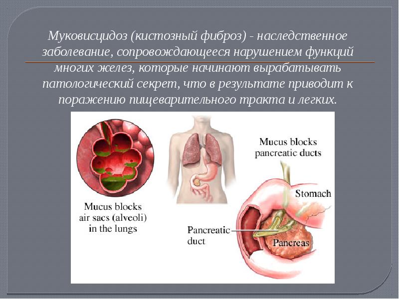 Муковисцидоз презентация по генетике