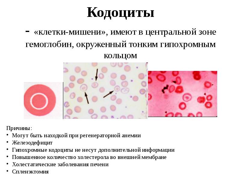 Кодоциты - «клетки-мишени», имеют в центральной зоне гемоглобин, окруженный тонким гипохромным Кодоциты - «клетки-мишени», имеют в центральной зоне гемоглобин, окруженный тонким гипохромным