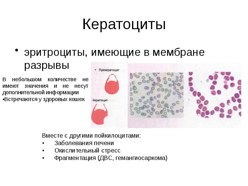 Кератоциты
эритроциты, имеющие в мембране разрывы Кератоциты
эритроциты, имеющие в мембране разрывы