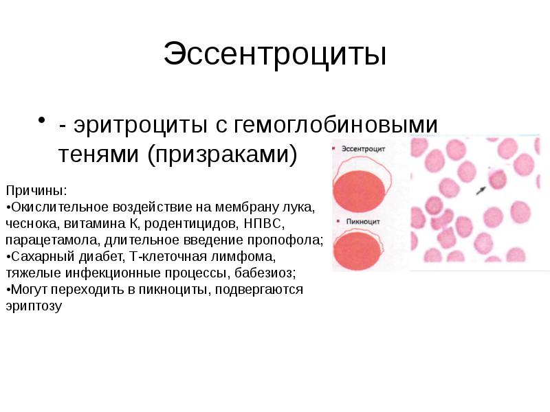 Эссентроциты
- эритроциты с гемоглобиновыми тенями (призраками) Эссентроциты
- эритроциты с гемоглобиновыми тенями (призраками)