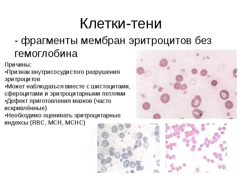 Клетки-тени
- фрагменты мембран эритроцитов без гемоглобина Клетки-тени
- фрагменты мембран эритроцитов без гемоглобина