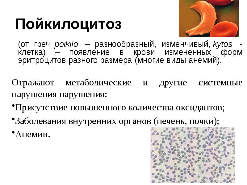 Пойкилоцитоз
(от греч. poikilo – разнообразный, изменчивый, kytos - клетка) – появление Пойкилоцитоз
(от греч. poikilo – разнообразный, изменчивый, kytos - клетка) – появление