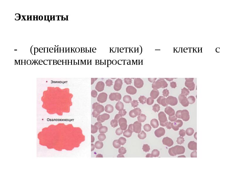 Эхиноциты
- (репейниковые клетки) – клетки с множественными выростами Эхиноциты
- (репейниковые клетки) – клетки с множественными выростами