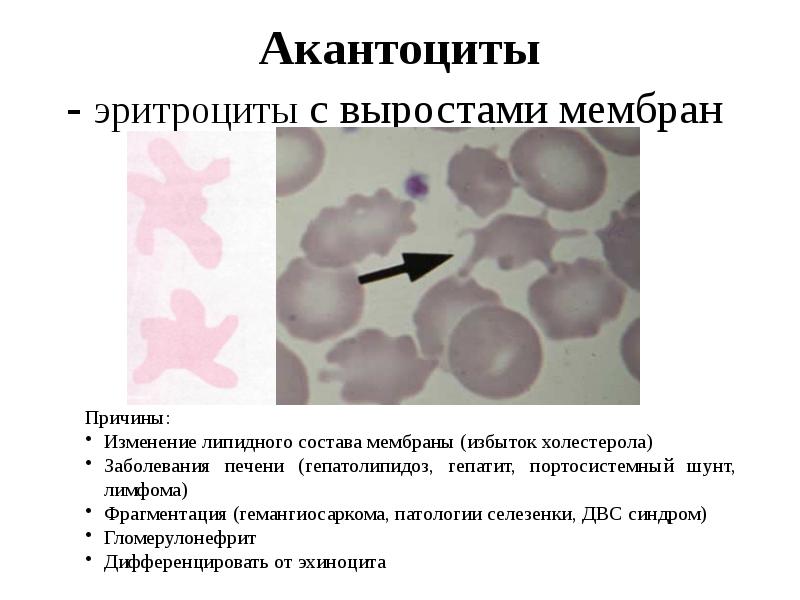 Акантоциты - эритроциты с выростами мембран Акантоциты - эритроциты с выростами мембран