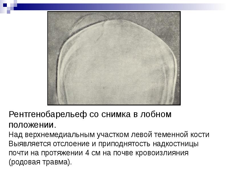 Перелом теменной кости у грудного. Линейный перелом теменной кости у грудного ребенка. Отслойка надкостницы рентген.