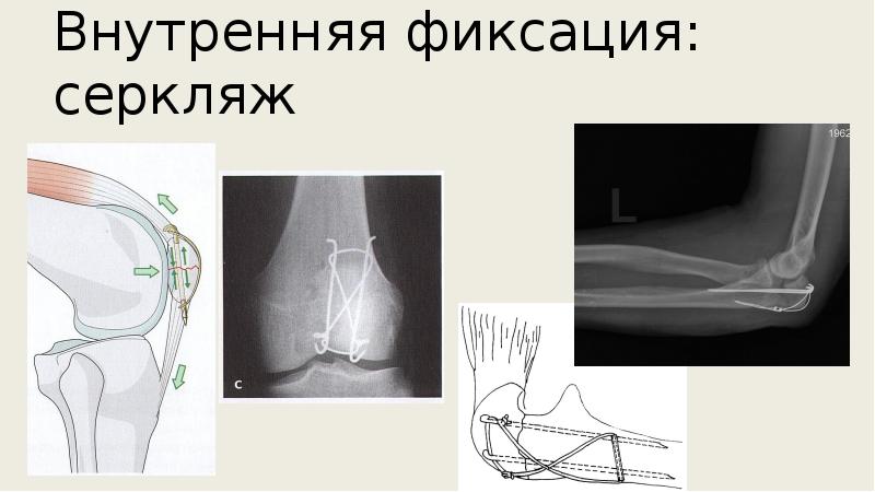 Травматология переломы презентация