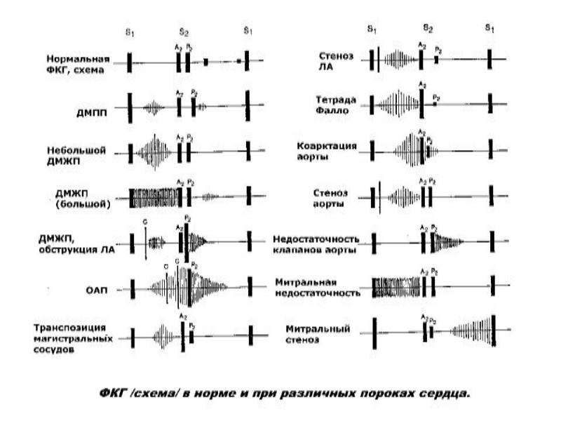 Графическое изображение тонов сердца