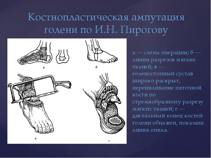 Травматическая ампутация голени карта вызова