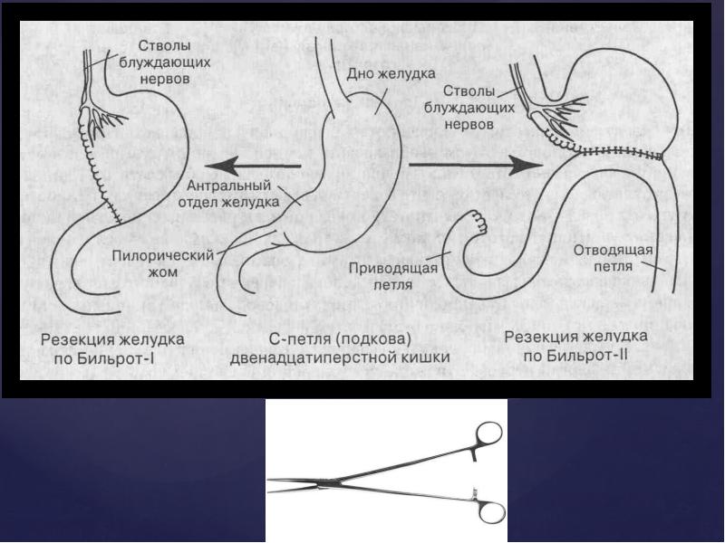 Бильрот 1 и 2 отличия схема