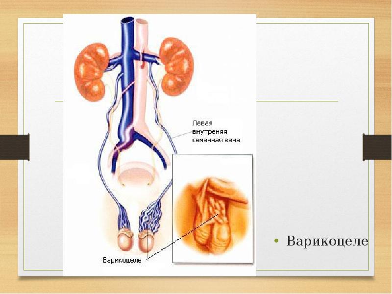 Варикоцеле Яйцах Фото