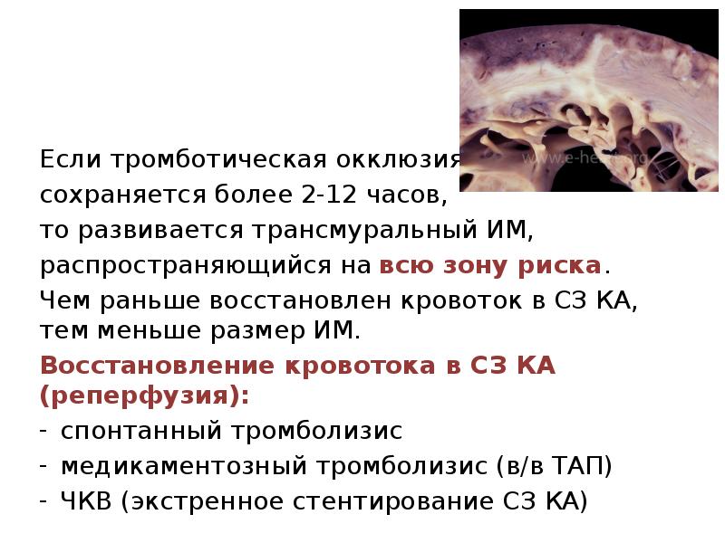 Прогрессирующая стенокардия мкб 10. Нестабильная стенокардия мкб 10. Восстановление кровотока. Неотложная терапия при тромботической окклюзии:.