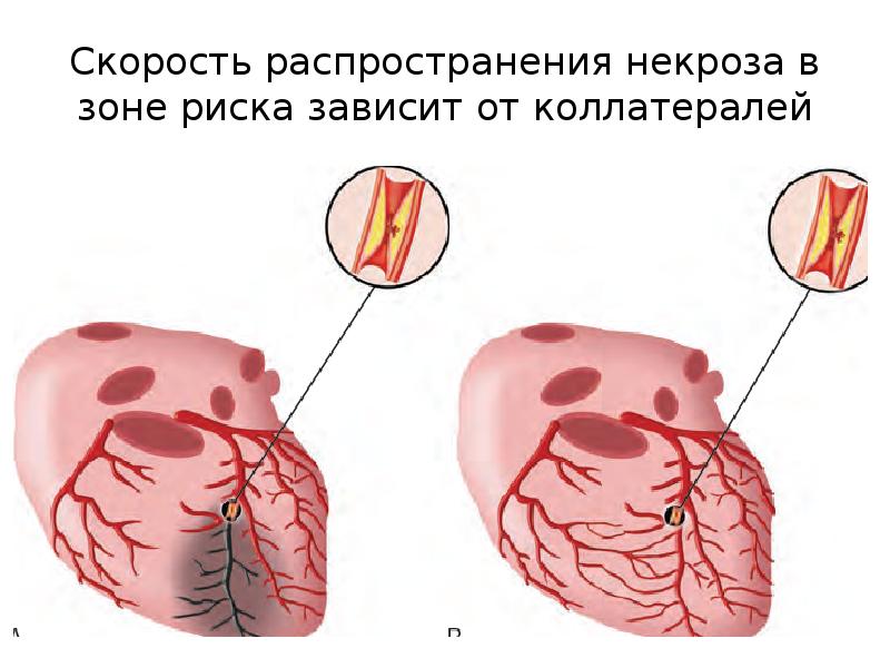 Окс нестабильная стенокардия. Нестабильная стенокардия и инфаркт миокарда. Распространение некроза. В зоне риска инфаркта миокарда. Острый коронарный синдром.