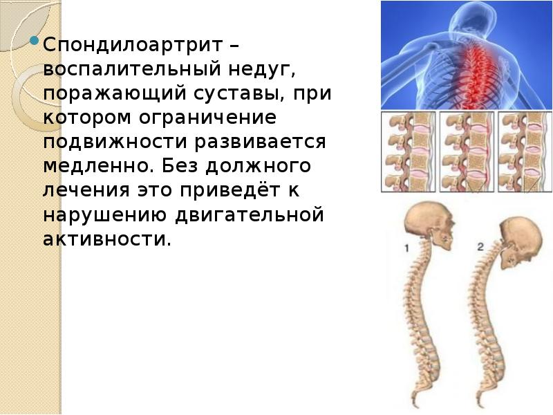 Спондилоартрит. Аксиальный спондилоартрит симптомы. Осевой спондилоартрит. Спондилоартрит периферических суставов.