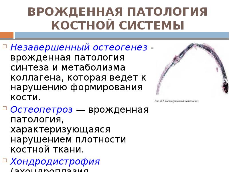ВРОЖДЕННАЯ ПАТОЛОГИЯ КОСТНОЙ СИСТЕМЫ Незавершенный остеогенез — врожденная патология синтеза и